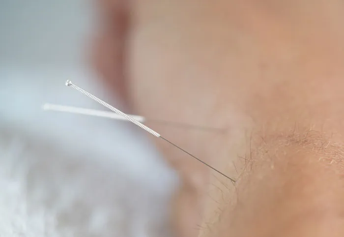 Acupunture_3_11zon